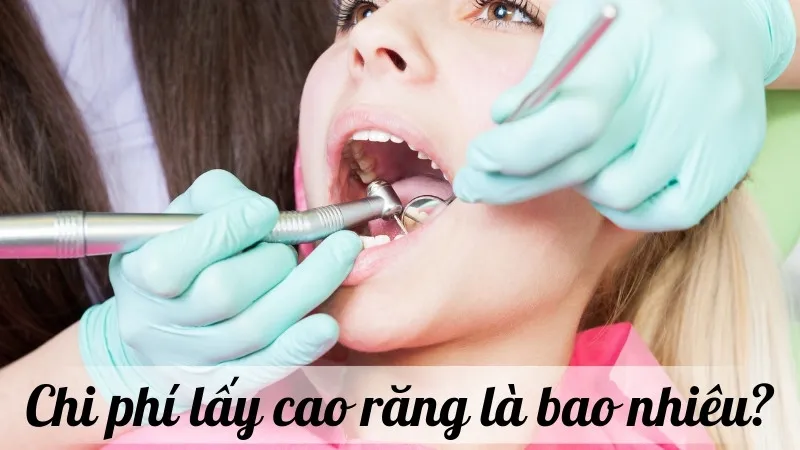 Chi phí lấy cao răng là bao nhiêu? Các yếu tố ảnh hưởng đến giá cả