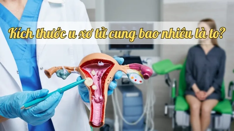 Kích thước u xơ tử cung bao nhiêu là to? Các dấu hiệu và hướng điều trị