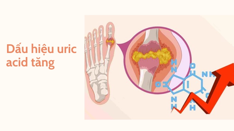 Dấu hiệu cảnh báo nồng độ acid uric tăng cao