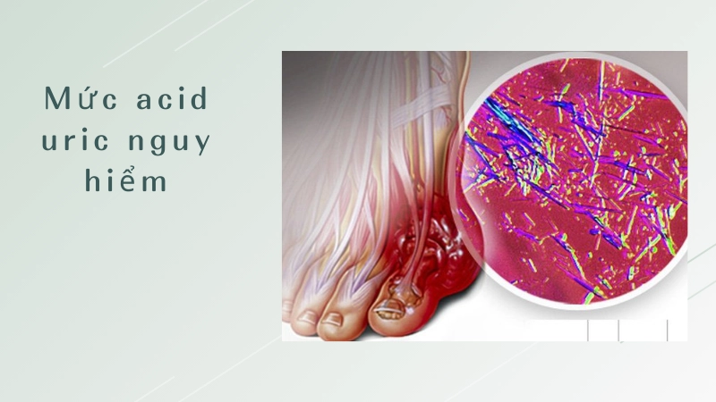 Ngưỡng acid uric nguy hiểm bạn cần lưu ý ngay