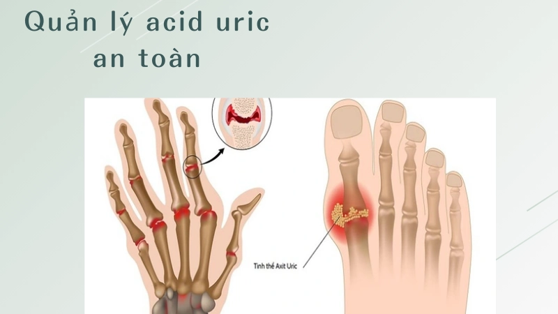 Cách kiểm soát acid uric để phòng ngừa biến chứng