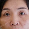 Cắt mí mắt size bao nhiêu thì đẹp chuẩn theo tỷ lệ vàng?
