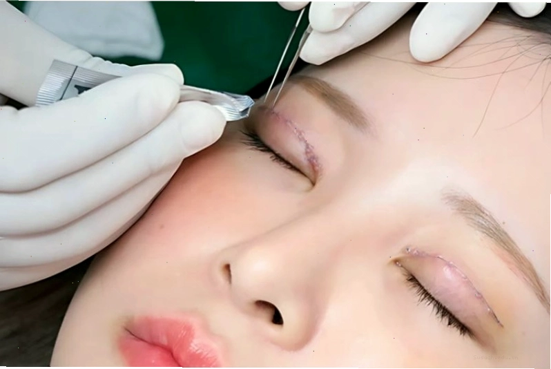Bác sĩ đang thực hiện kỹ thuật nhấn mí cho khách hàng