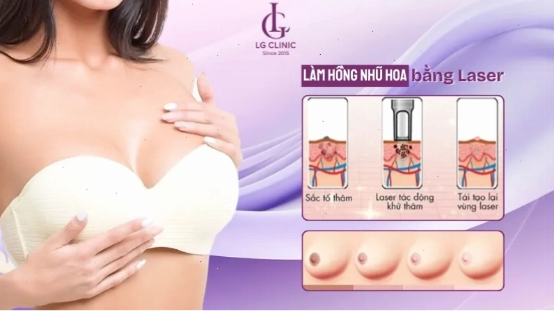 Bảng so sánh chi tiết hai phương pháp làm hồng nhũ hoa