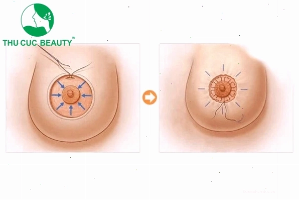 Biểu đồ giá dịch vụ thu nhỏ quầng nhũ hoa