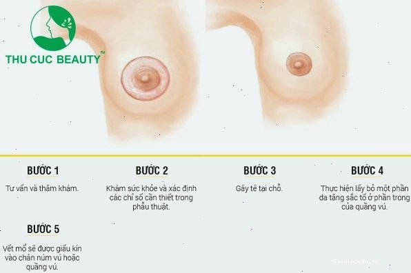 Các bước trong quy trình thu nhỏ quầng nhũ hoa
