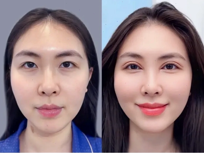 Cắt mí giúp khách hàng khắc phục tình trạng sụp mí, nếp mí không đều