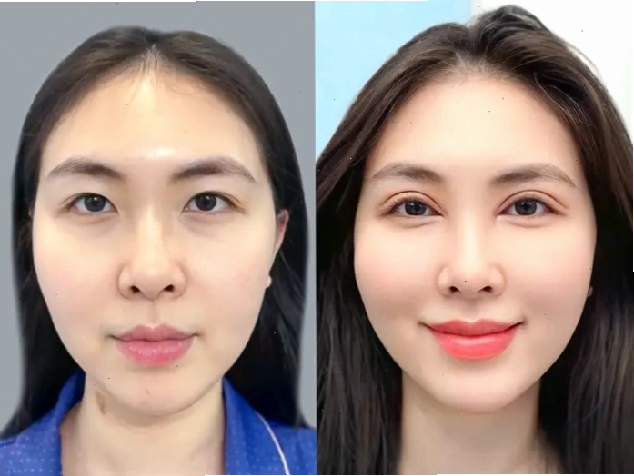 Cắt mí Hàn Quốc giúp tạo đôi mắt hai mí tự nhiên và cân đối