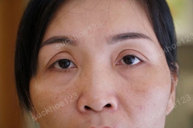 Cắt mí mắt size bao nhiêu thì đẹp chuẩn theo tỷ lệ vàng?