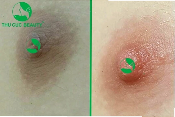Chi phí làm hồng nhũ hoa phụ thuộc vào phương pháp thực hiện