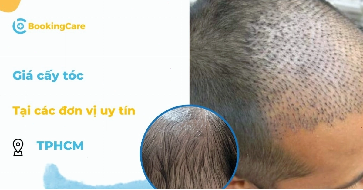 Giá cấy tóc tại TP.HCM đa dạng theo nhiều yếu tố