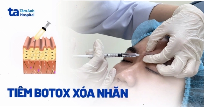 Hiệu quả tạo hình khuôn mặt sau khi tiêm filler