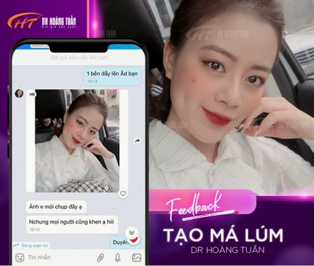 Hình ảnh thực tế sau khi tạo má lúm đồng tiền, cho thấy hiệu quả tự nhiên