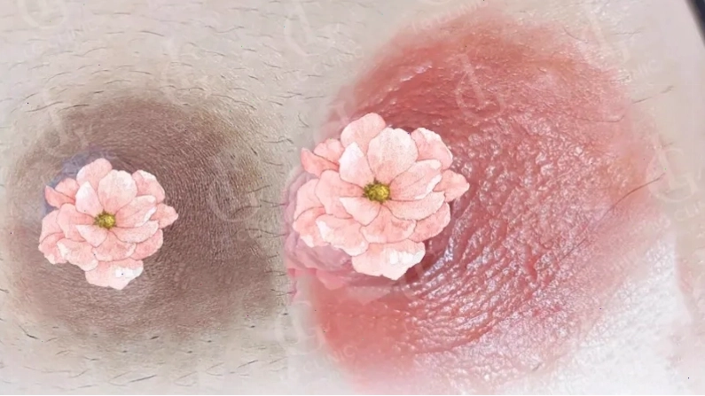 Hướng dẫn chăm sóc sau khi làm hồng nhũ hoa