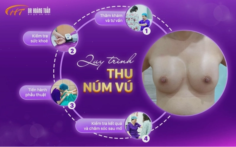 Hướng dẫn chăm sóc sau phẫu thuật thu nhỏ quầng nhũ hoa
