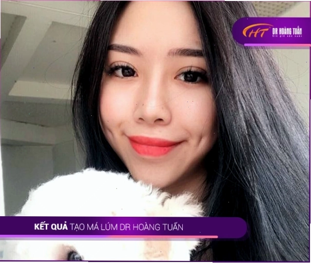 Kết quả thẩm mỹ tạo má lúm đồng tiền