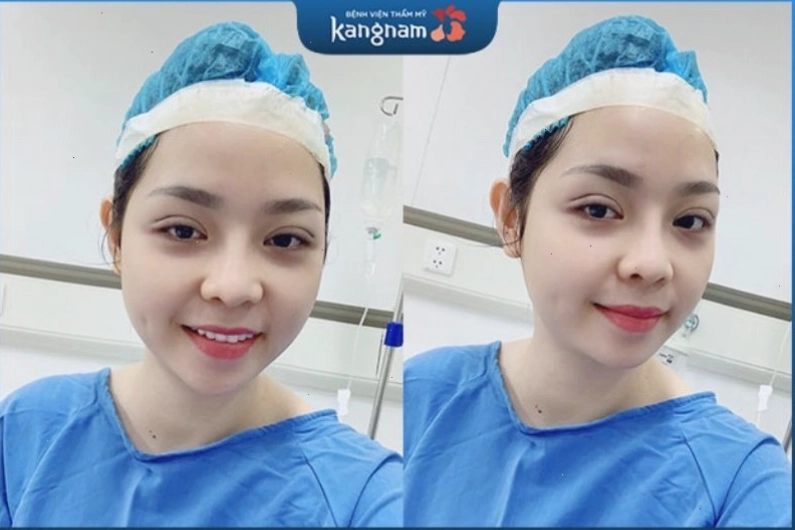 Khách hàng hài lòng với kết quả nhấn mí tại Bệnh viện Thẩm mỹ Kangnam