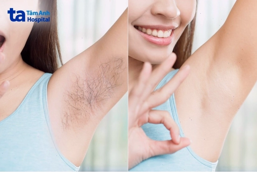 Lưu ý khi lựa chọn dịch vụ triệt lông vùng kín