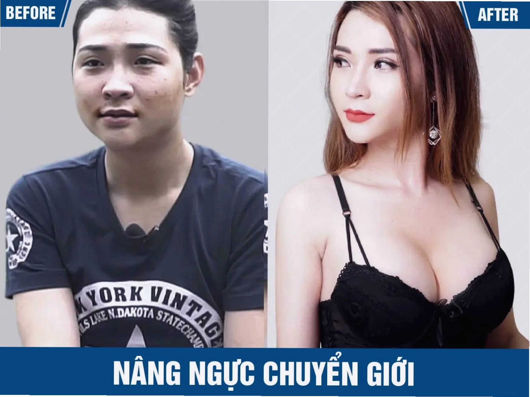 Nâng ngực cho người chuyển giới