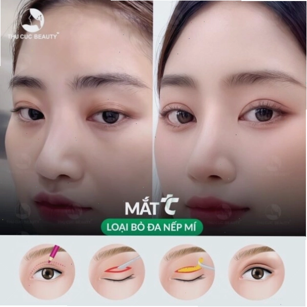 Nếp mí đẹp tự nhiên sau khi cắt mí mắt