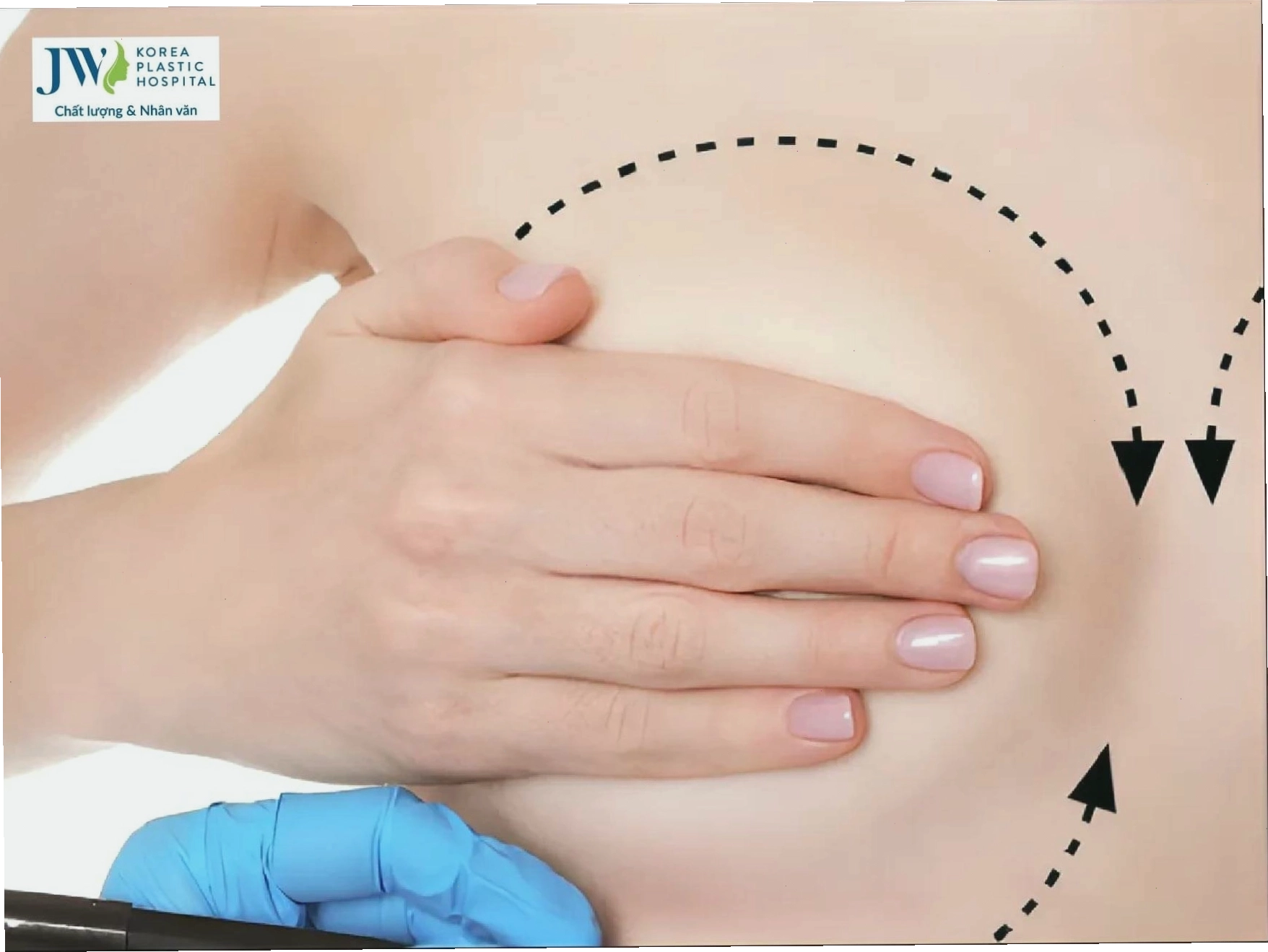 Những trường hợp nên thực hiện nâng ngực