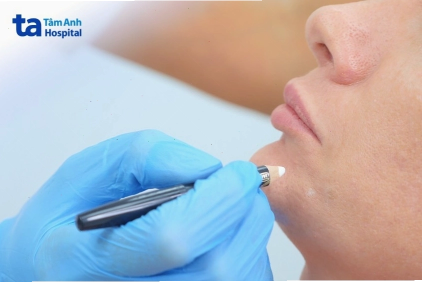 Quy trình tiêm BAP 5 điểm tại bệnh viện Đa khoa Tâm Anh