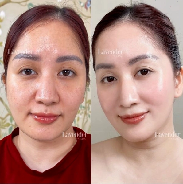 So sánh chi phí Thermage FLX với các phương pháp trẻ hóa da khác