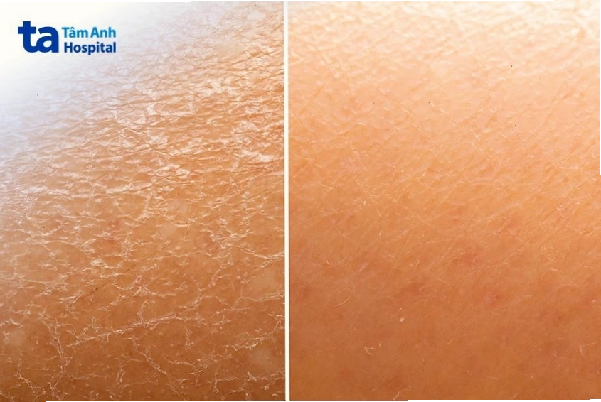 Tác dụng của tiêm BAP 5 điểm
