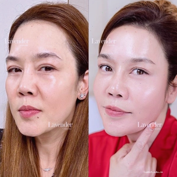Tư vấn bác sĩ về Thermage FLX