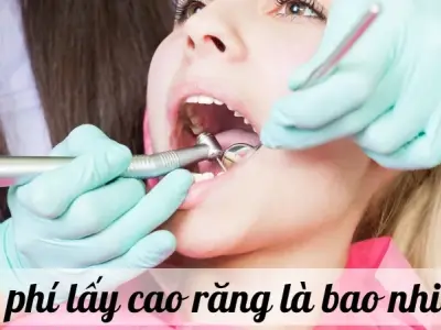Chi phí lấy cao răng là bao nhiêu? Các yếu tố ảnh hưởng đến giá cả