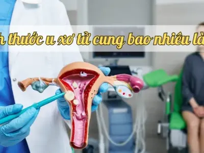 Kích thước u xơ tử cung bao nhiêu là to? Các dấu hiệu và hướng điều trị