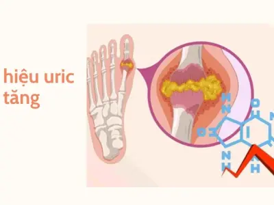 Chỉ số acid uric bao nhiêu là bị gout? Kinh nghiệm xương máu