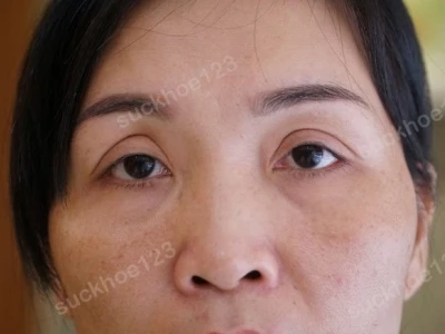 Cắt mí mắt size bao nhiêu thì đẹp chuẩn theo tỷ lệ vàng?