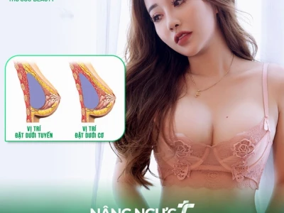 Nâng ngực giá bao nhiêu tiền? Cẩm nang chi tiết 2026