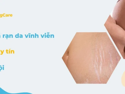 Trị Rạn Da Bằng Laser Bao Nhiêu Tiền? Cập Nhật Giá 2026